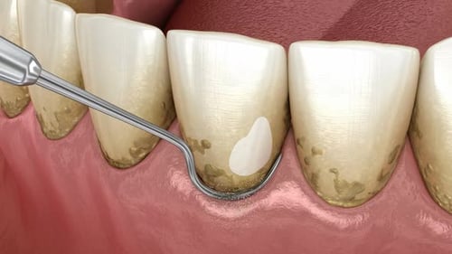 Oral hygiene: Scaling and root planing (conventional periodontal therapy).