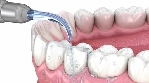 Irrigator, Water teeth cleaning