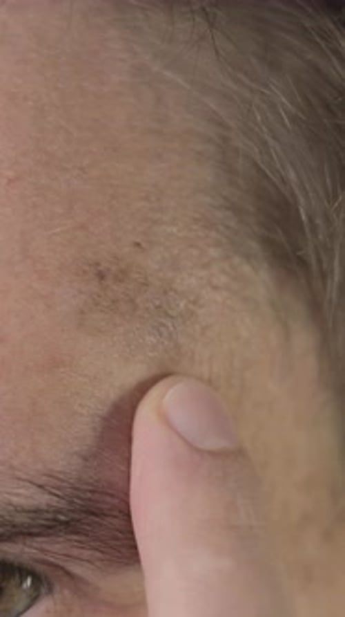 Vertical footage of a pigmented spots on the forehead