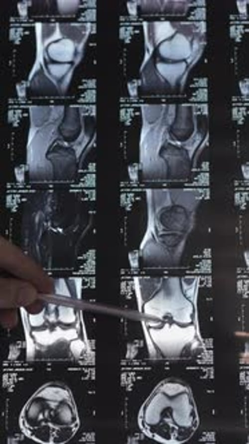 RMN de la articulación de rodilla