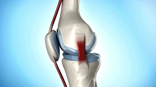 Primer plano de la articulación de la rodilla y la artritis
