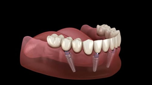 Mandibular prosthesis All on 4 system supported by implants.