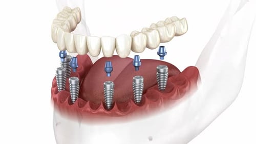 Removable mandibular prosthesis all on 6 system supported by implants