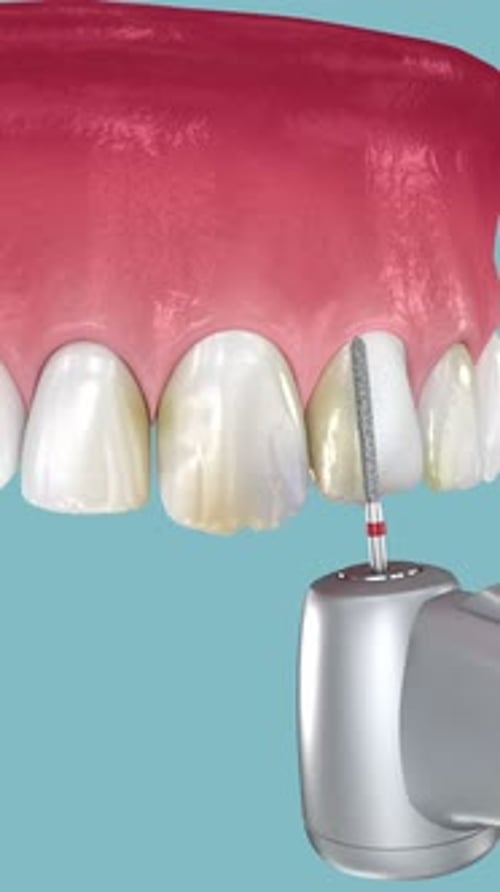 Dental veneers placement over teeth and happy smile at the end. 3D animation