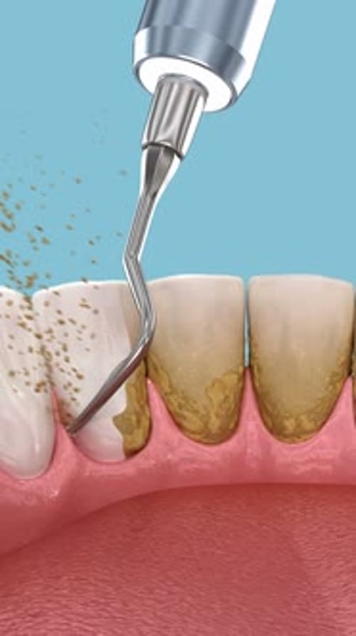 Oral hygiene: Scaling and root planing (conventional periodontal therapy). Medically accurate 3D Ani