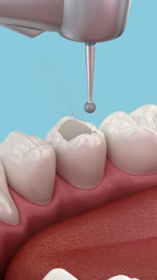 Proceso de
tratamiento endodóntico de endodoncia. Animación 3D de dientes con precisión médica