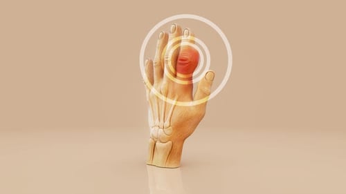 Animación 3D conceptual de la gota en la articulación del dedo y la inflamación