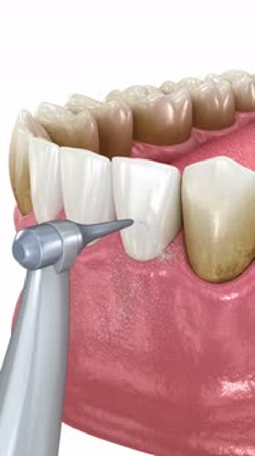 Oral hygiene: Air flow teeth cleaning process. Dental 3D animation