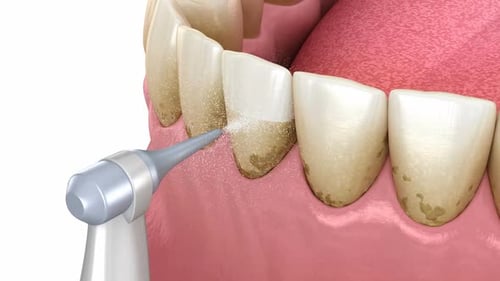 Oral hygiene: Air flow water Teeth Cleaning