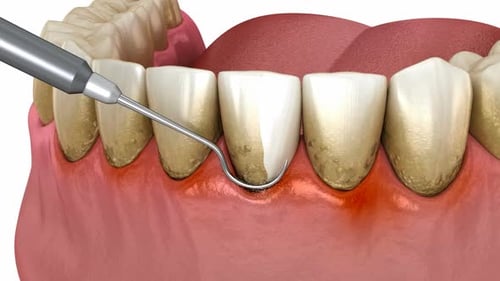 Dental scaling (conventional periodontal therapy)