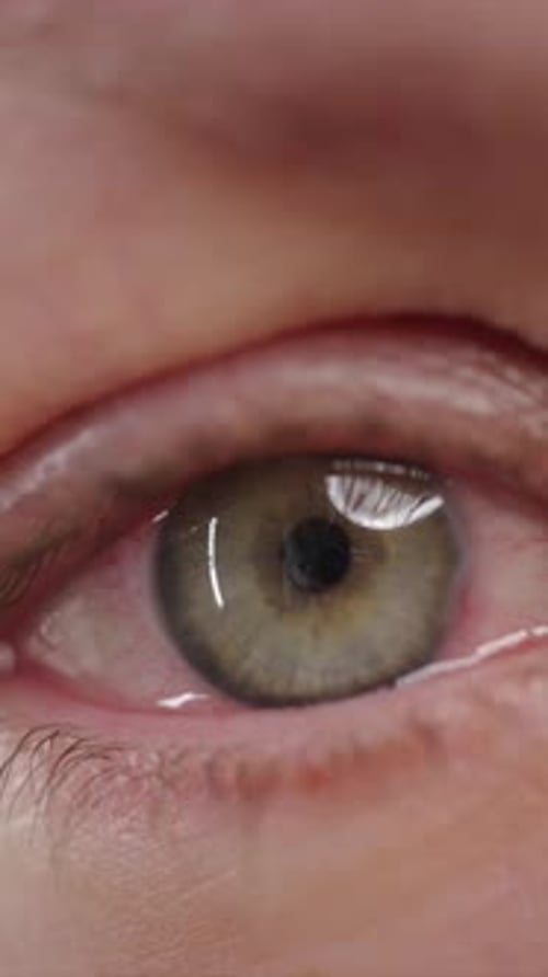 Red Blood Eye of Woman Affected By Conjunctivitis or After Flu Cold or Allergy