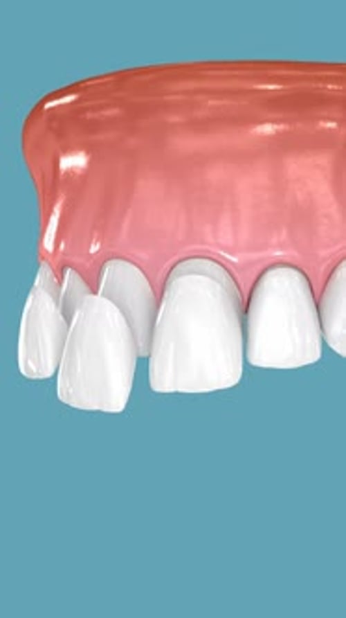 Dental veneers on blue background. 3D Animation