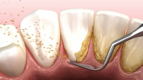 Oral hygiene: Ultrasonic teeth cleaning machine removing calculus and plaque.