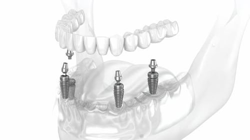 Mandibular prosthesis all on 4 system supported by implants. Dental 3D animation