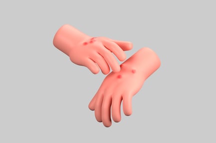 Preview: Hands with Rash